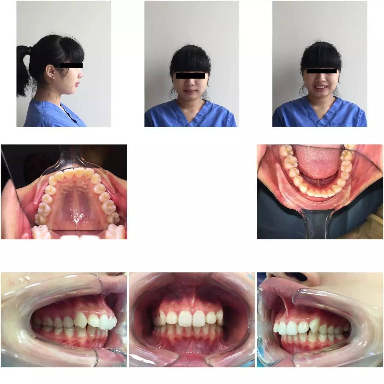 整牙变美第一步,整牙变脸