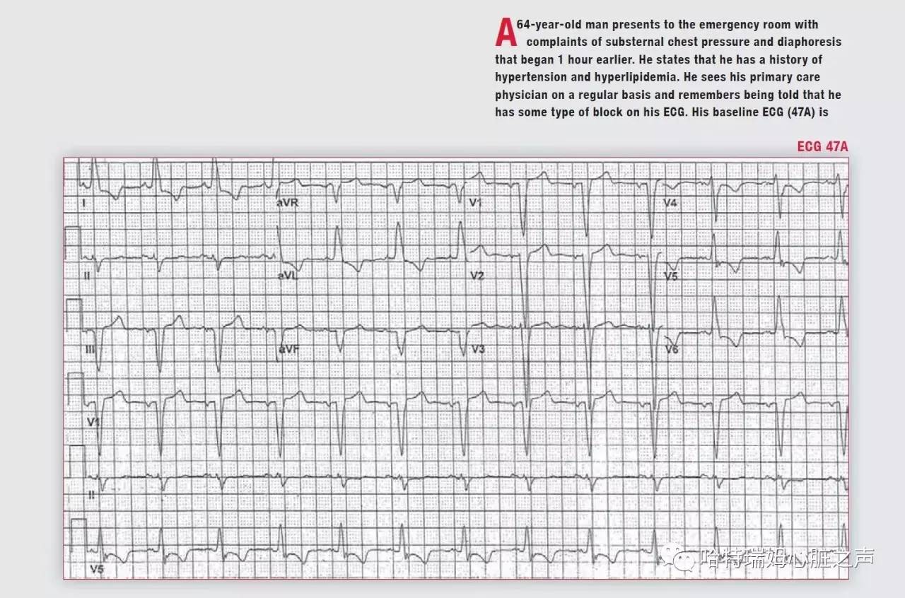 左束支阻滞会引起心梗吗,急性前间壁心肌梗死怎么治疗