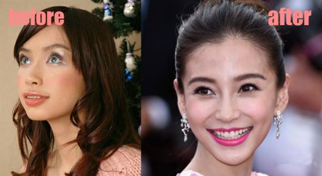 整牙变美第一步,整牙变脸