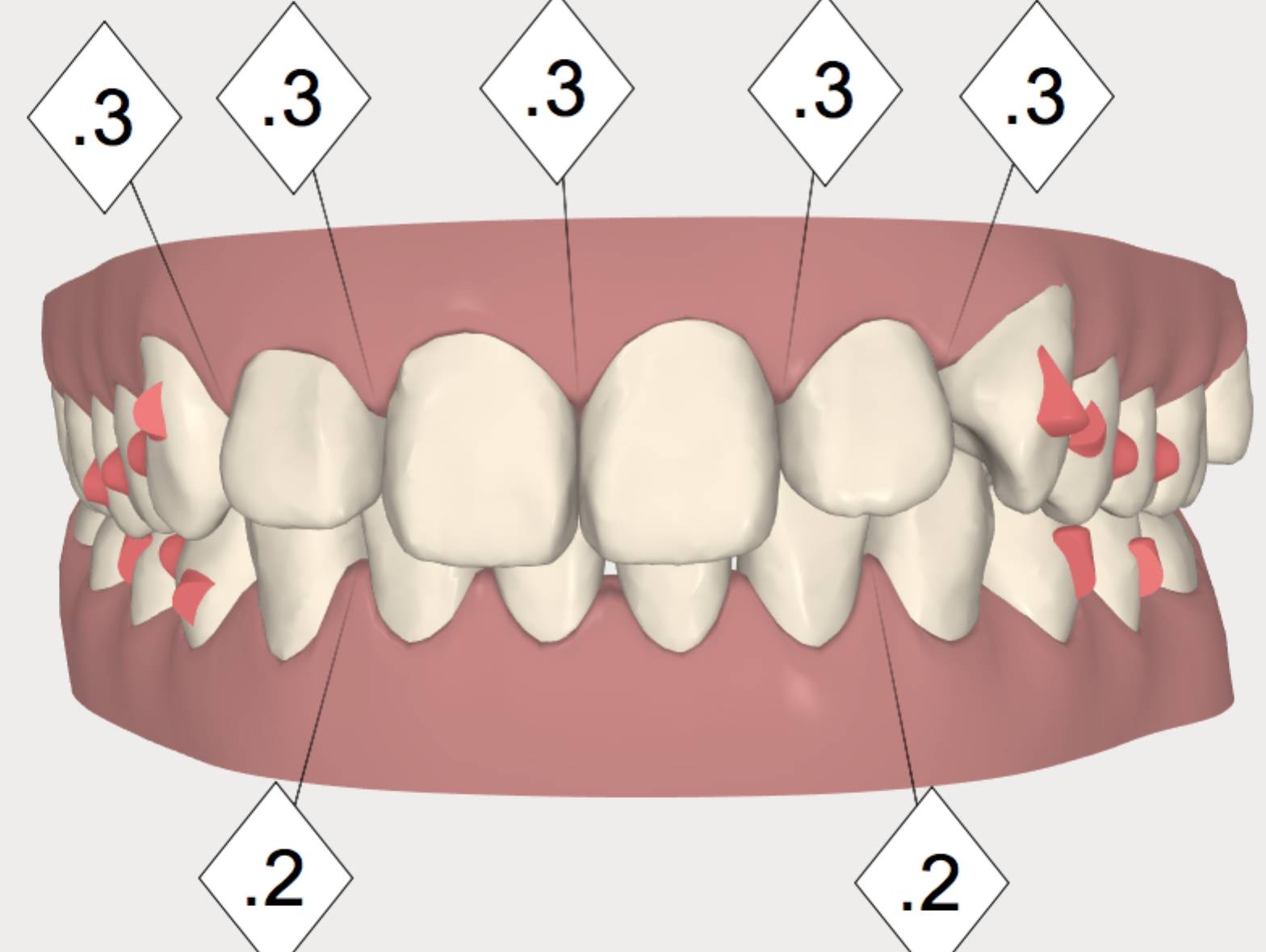 整牙变美第一步,整牙变脸