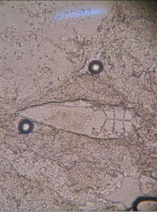 杭州一男子因眼睛奇痒就医，睫毛里竟爬出3条虫！