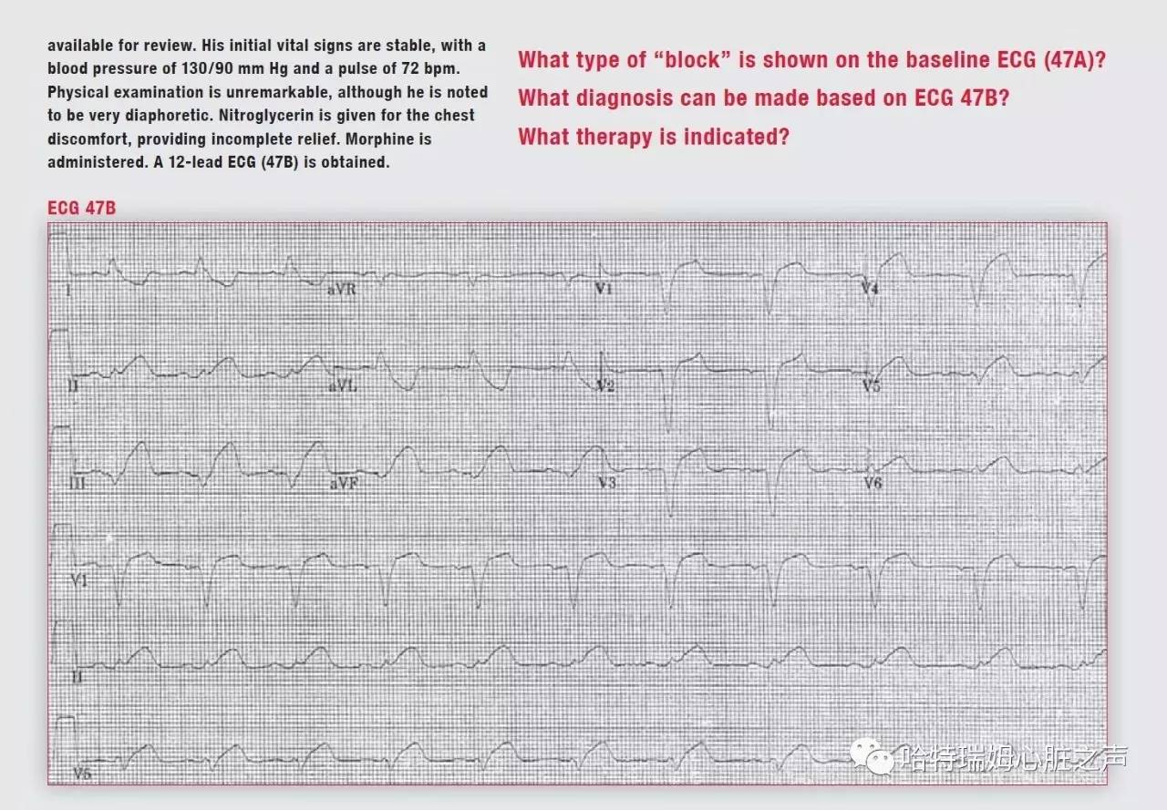 左束支阻滞会引起心梗吗,急性前间壁心肌梗死怎么治疗