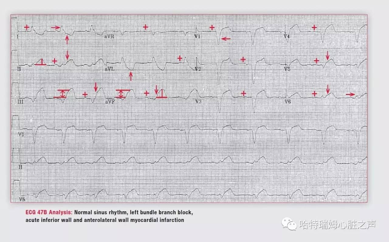 左束支阻滞会引起心梗吗,急性前间壁心肌梗死怎么治疗
