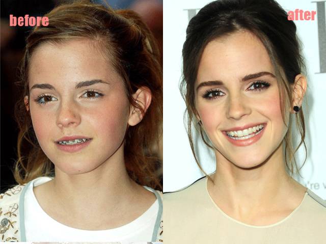 整牙变美第一步,整牙变脸