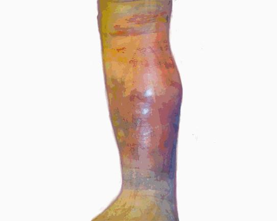 杏林中医院治静脉曲张吗,静脉曲张科普一下