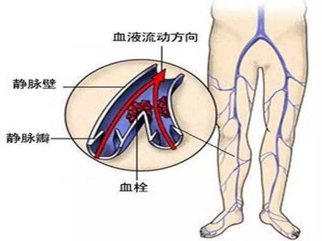 杏林中医院治静脉曲张吗,静脉曲张科普一下