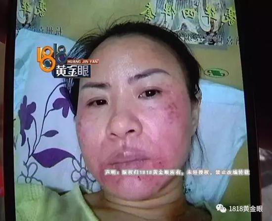 浙江女子用了姐妹推荐的美容产品觉得脸被毁老公要离婚