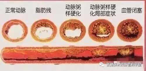 怎么让血管不长斑,消除血管斑的最佳方法