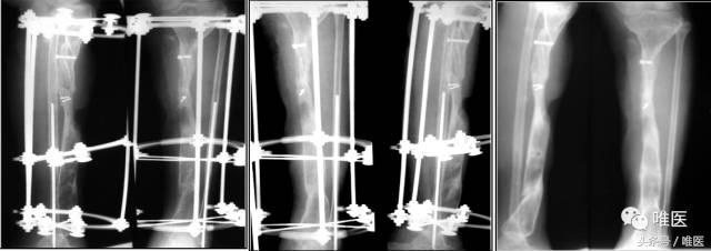 胫骨平台骨缺损处理,胫骨下端部分骨缺损如何植骨