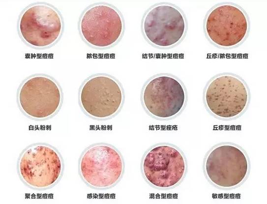 常见痘痘长什么样,常见的痘痘种类