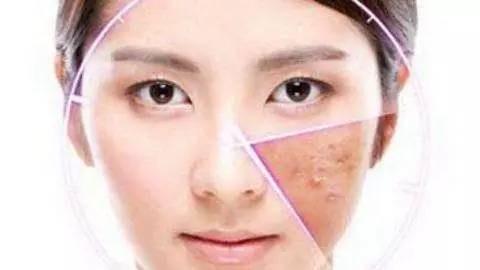 得了激素脸怎么办,排激素脸祛痘发现痘痘更加严重了