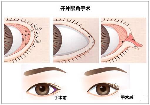 开眼角是把眼睛变大还是变长,开眼角是能让眼睛变长还是变大