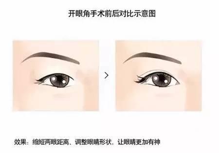 开眼角是把眼睛变大还是变长,开眼角是能让眼睛变长还是变大