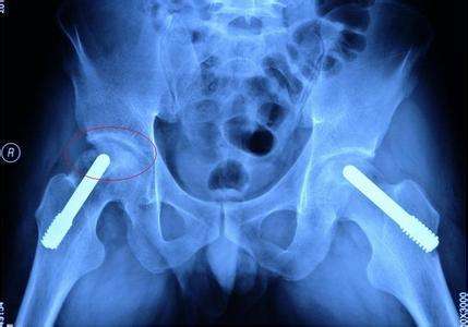 股骨头坏死肌肉萎缩能恢复正常吗,股骨头坏死肌肉萎缩能自愈吗