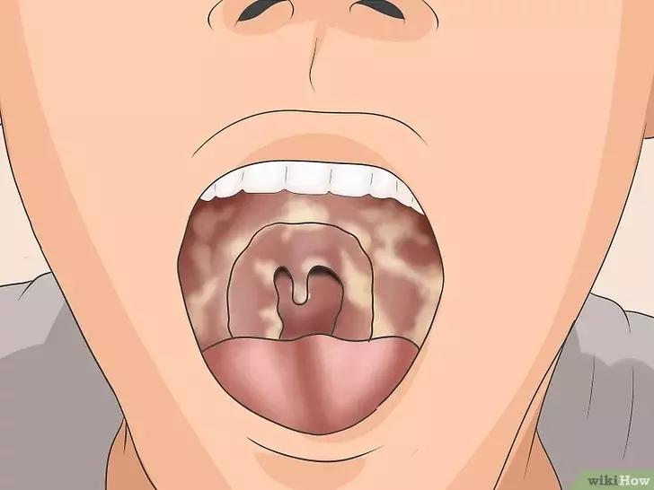 如何判断咽喉炎是不是细菌性感染,抗链球菌高引起的咽喉炎怎么治疗