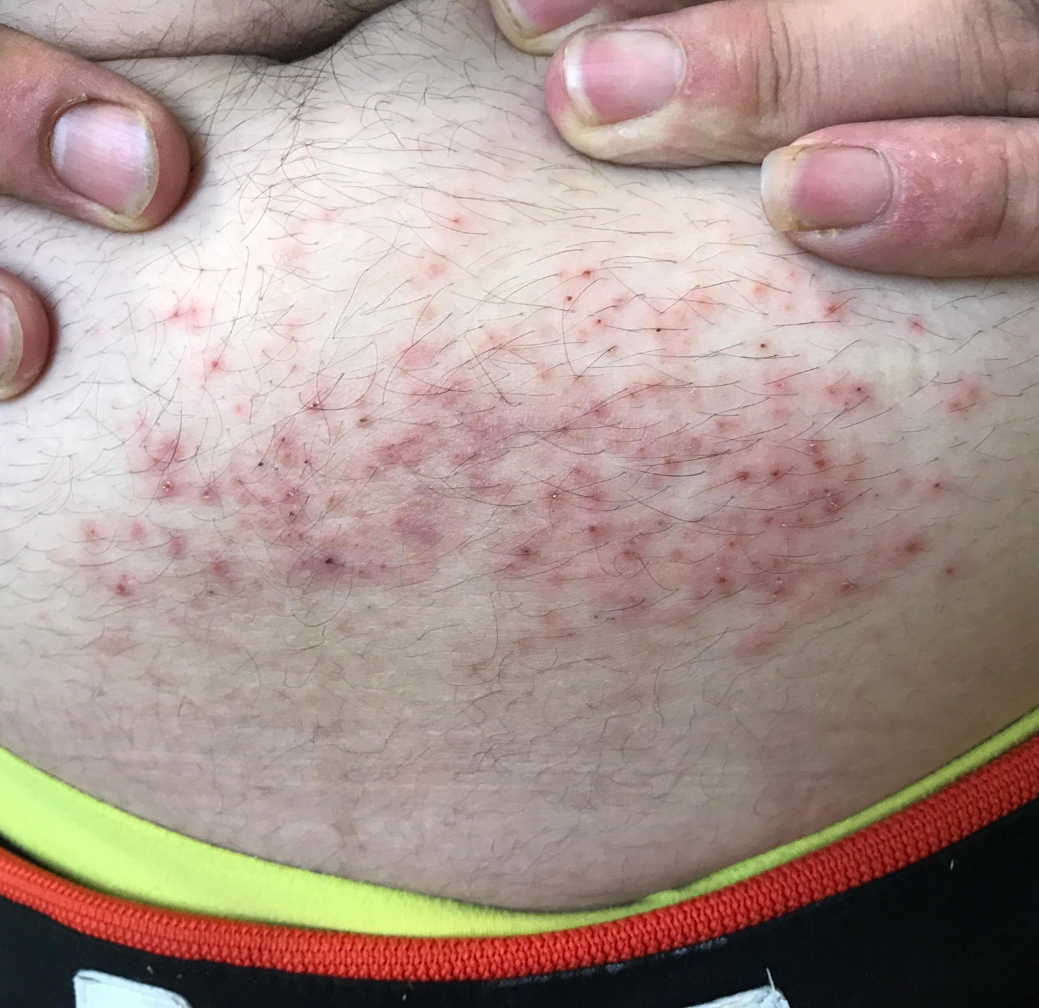 肚子因为皮带扣过敏怎么办,肚子系皮带的位置有疹子