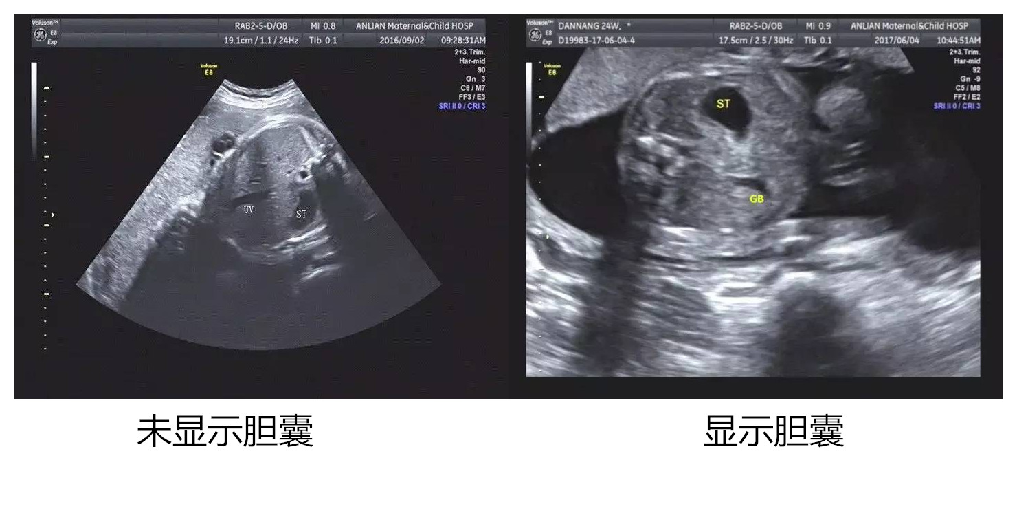 胎儿28周胆囊未显示怎么回事,孕30周胎儿胆囊未见显示该怎么办