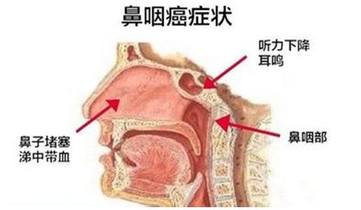 鼻炎会发展成鼻咽癌吗?如何有效预防鼻咽癌?