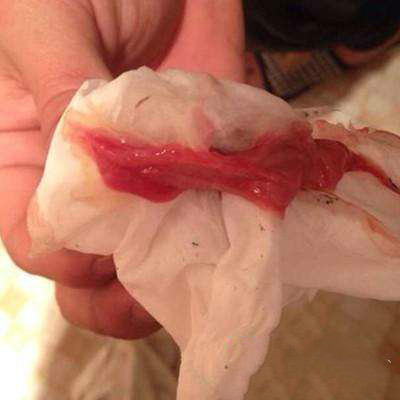 产后26天恶露反复是咖啡色,产后40天恶露反复