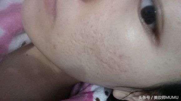痘坑等于毁容!能修复得好吗?