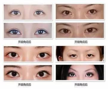 开眼角是把眼睛变大还是变长,开眼角是能让眼睛变长还是变大