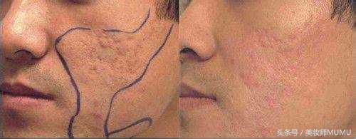 痘坑等于毁容!能修复得好吗?