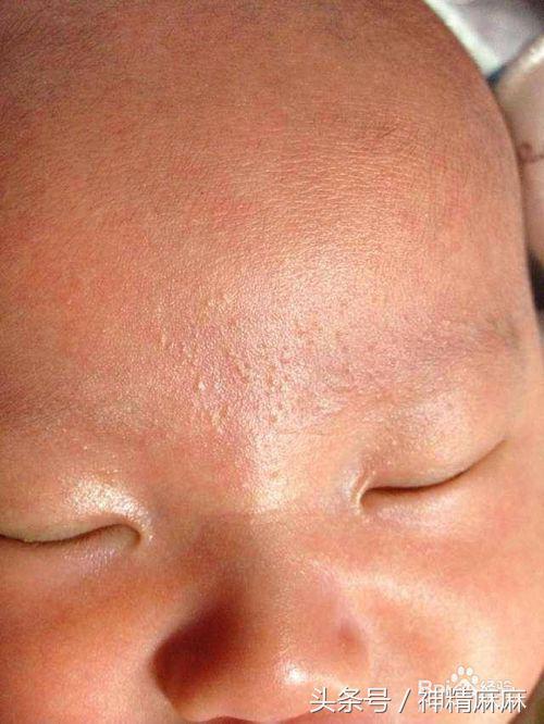 痱子湿疹荨麻疹怎么区分,湿疹麻疹痱子