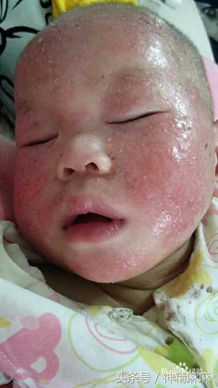 痱子湿疹荨麻疹怎么区分,湿疹麻疹痱子