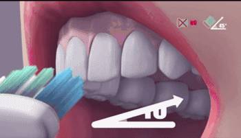 洗牙牙斑清除全过程,小妙招去牙黄