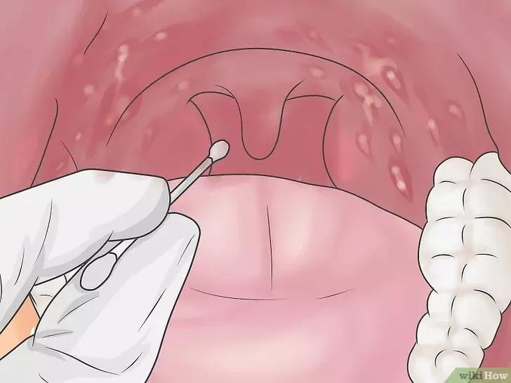 如何判断咽喉炎是不是细菌性感染,抗链球菌高引起的咽喉炎怎么治疗