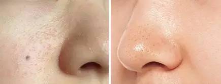 常见痘痘长什么样,常见的痘痘种类