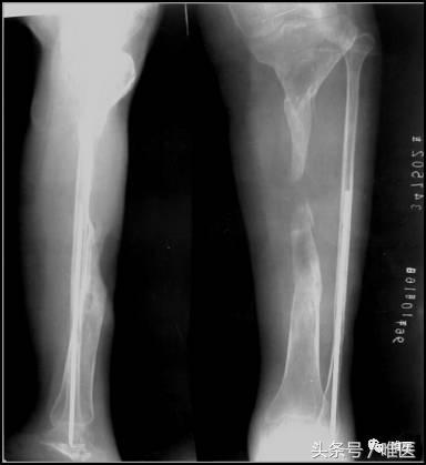 胫骨平台骨缺损处理,胫骨下端部分骨缺损如何植骨