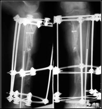 胫骨平台骨缺损处理,胫骨下端部分骨缺损如何植骨