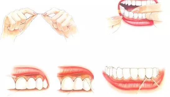 洗牙牙斑清除全过程,小妙招去牙黄