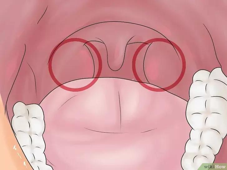 如何判断咽喉炎是不是细菌性感染,抗链球菌高引起的咽喉炎怎么治疗