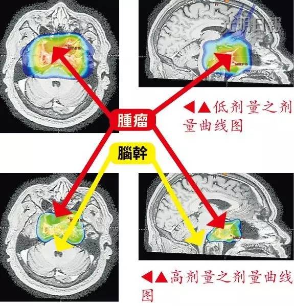 质子肿瘤放射治疗技术效果,放射粒子技术治疗癌症