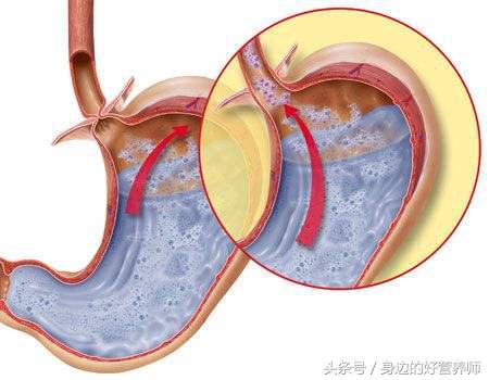 感觉胃酸多是什么原因,感觉胃酸多吃什么可以缓解