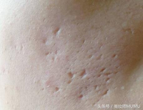 痘坑等于毁容!能修复得好吗?