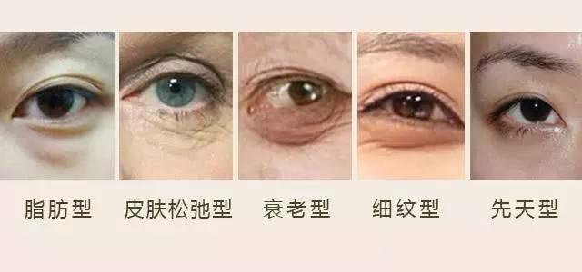 卧蚕眼袋黑眼圈傻傻分不清楚,卧蚕和眼袋的区别图片对比