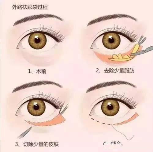 卧蚕眼袋黑眼圈傻傻分不清楚,卧蚕和眼袋的区别图片对比