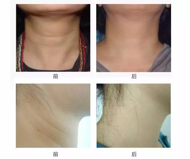 颈纹到底是什么样子,颈纹是什么样的