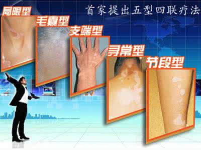 身上长白斑是白癜风吗如何确诊,身上出现白斑都是白癜风吗
