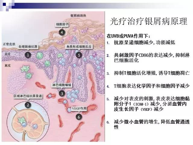 光疗治疗银屑病怎么样有副作用吗,脓疱型银屑病可以光疗吗