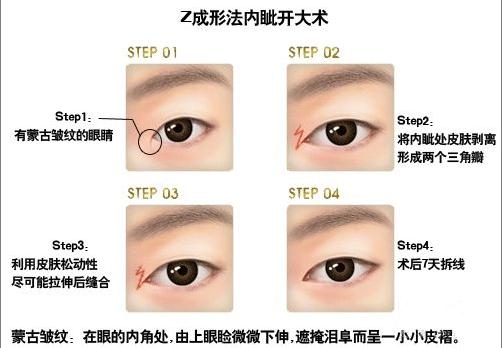 眼睛整形开眼角,眼睛变大的方法手术