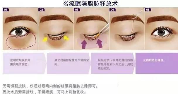 卧蚕眼袋黑眼圈傻傻分不清楚,卧蚕和眼袋的区别图片对比