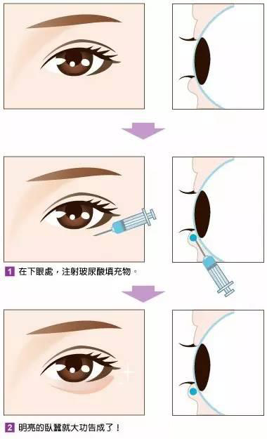 卧蚕眼袋黑眼圈傻傻分不清楚,卧蚕和眼袋的区别图片对比