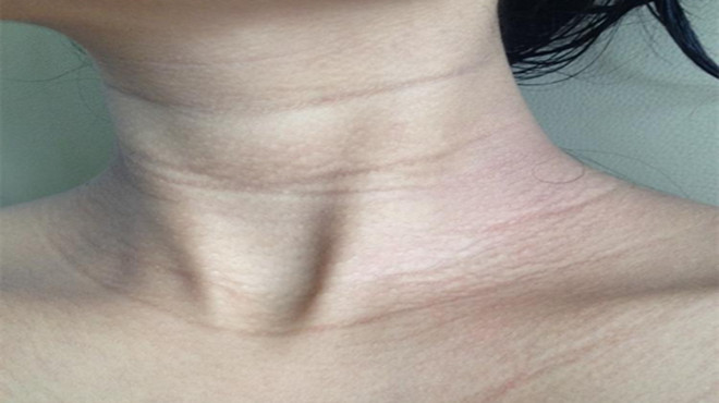 脖子有皱纹怎么消除最有效,脖子皱纹怎么消除