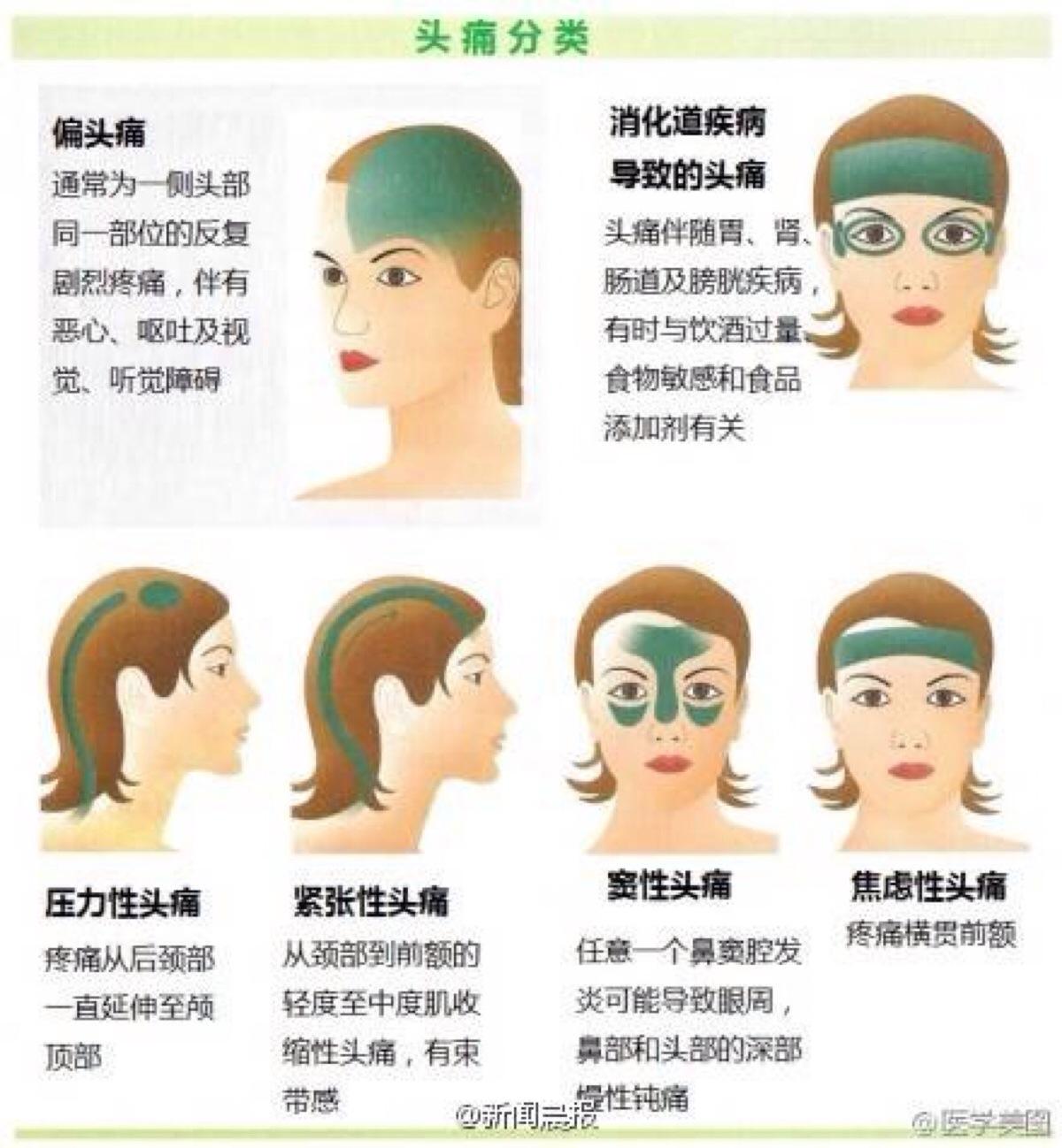 有什么简单的方法可以治头疼,头疼要重视