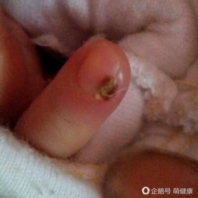 女生手有倒刺化脓,十岁女孩手上长满倒刺