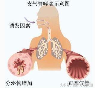你咳什么样的痰，我就知道你得的是什么病！